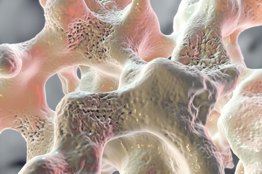 osteoporosis illustration