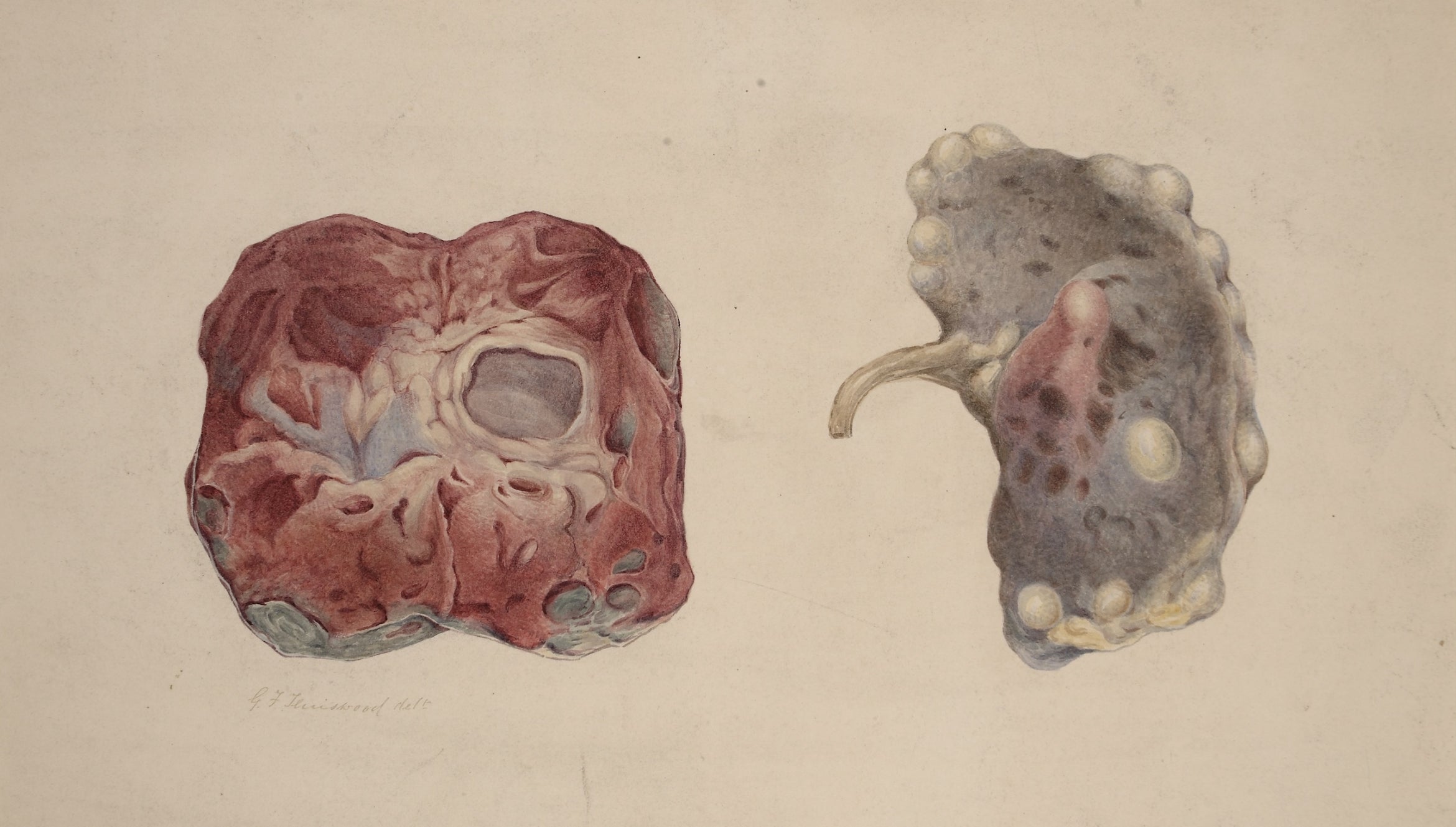 1880-1893 medical watercolor image of polycystic kidney