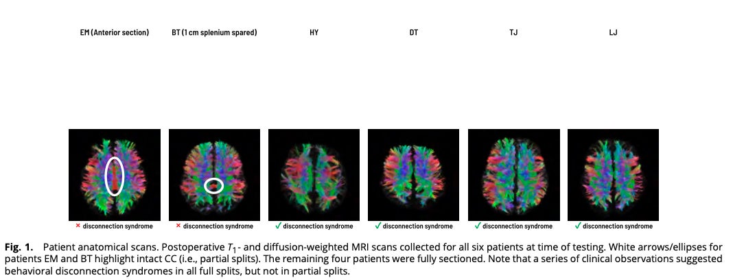 A figure of fMRI scans of split-brain patients